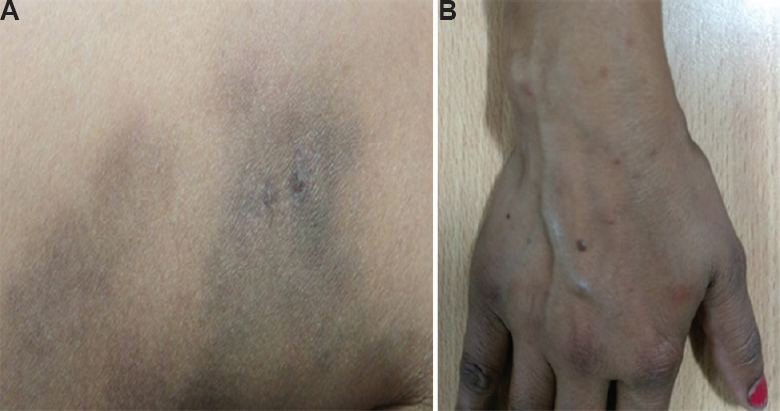 (A) Hyperpigmented ill-defined macular rash on medial aspect of the right thigh. (B) Petechial rashes on the hand and forearm.
